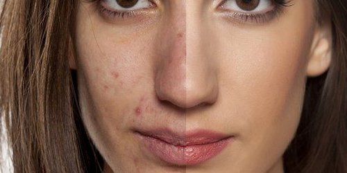 acne low carb
